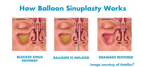 Balloon Sinuplasty – The Midwest Sinus Center