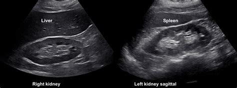 Acute Kidney Injury Ultrasound