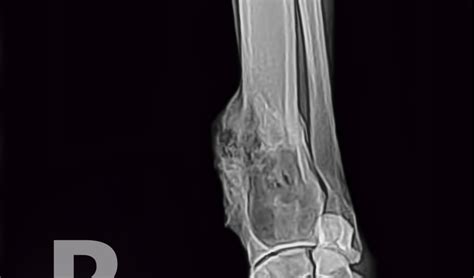 Osteosarcoma in Dogs | PetCoach