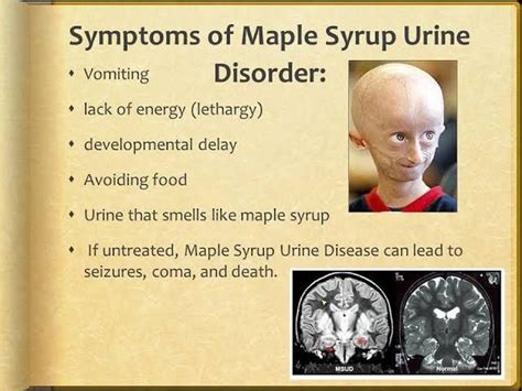 Maple syrup urine disease symptoms - MEDizzy