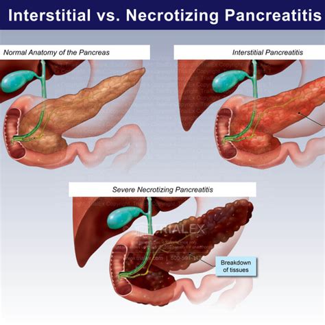 Interstitial vs Necrotizing Pancreatitis - TrialExhibits Inc.