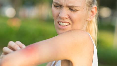 Are Home Remedies In Fort Worth Effective To Deter Stinging Insects?