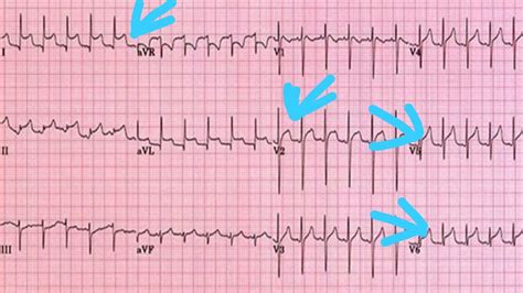 Ecg In Pericardial Effusion | My XXX Hot Girl