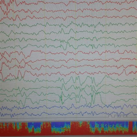 (PDF) Abdominal epilepsy, an uncommon cause of chronic and recurrent abdominal pain: a case report