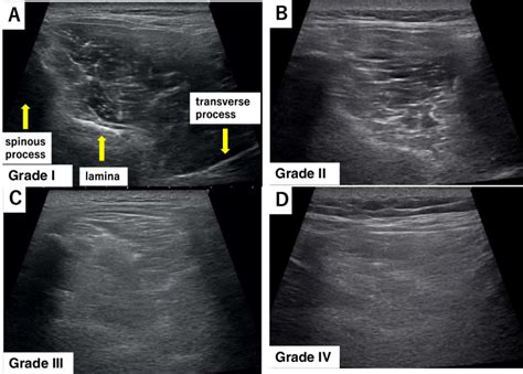 Heckmatt score: The classification of muscle echogenicity. (A) normal... | Download Scientific ...