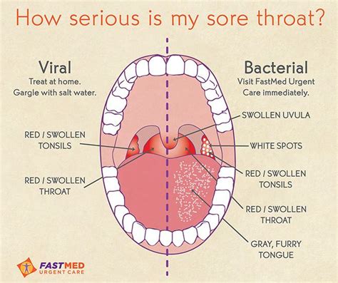 Amandel, Radang Tenggorokan, Strep Throat? - Pasien Sehat