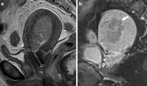 Endometrial cancer FIGO IA. a Sagittal T2-weighted and b para-sagittal... | Download Scientific ...