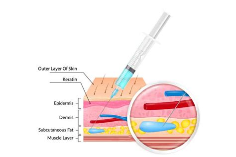 Administering Subcutaneous Injections | Ausmed