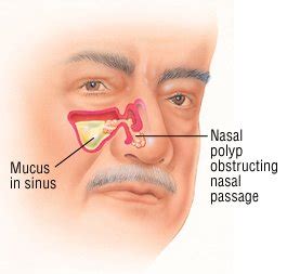 Nasal Polyps Guide: Causes, Symptoms and Treatment Options