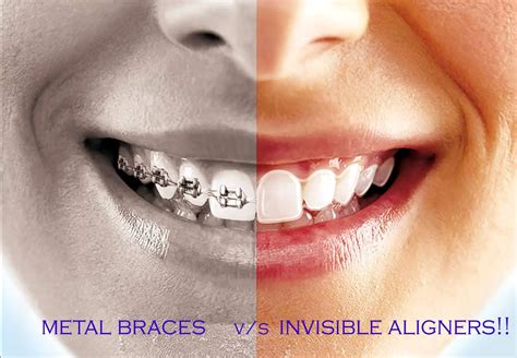 Clear Braces vs. Invisible Aligners—What’s the Difference? - DentalsReview