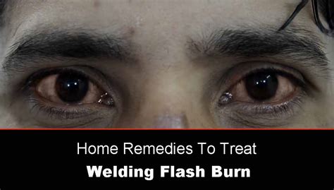 Welding Flash Burn Eyes Home Treatment [12 Simple and Effective Ways] - cruxweld