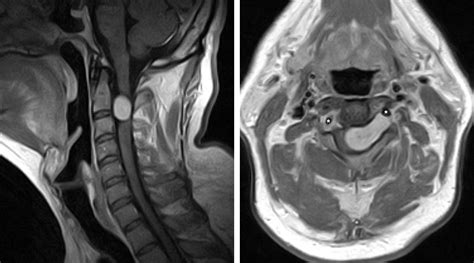 Extramedullary Spinal Cord Tumor | The Neurosurgical Atlas, by Aaron Cohen-Gadol, M.D.