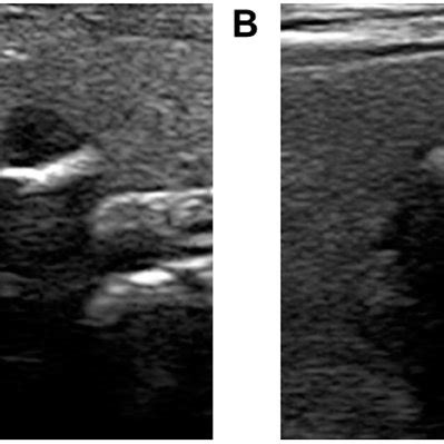 Typical ultrasound images for ACR TI-RADS 4−5 nodules with coarse... | Download Scientific Diagram