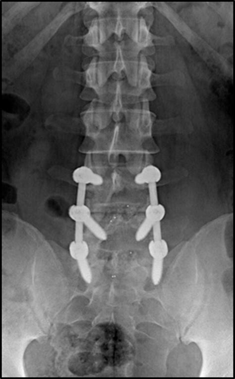 Spinal Reconstruction and Fusion