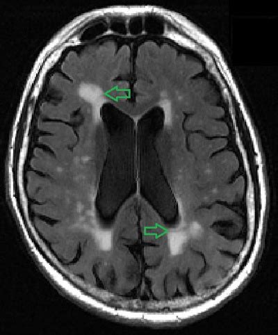 New calculator assesses cognitive decline on brain MRI Scan - Scan For Life