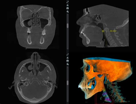 Cone Beam CT — Sleep and Brain