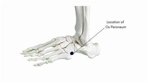 Os Peroneum Syndrome: Get the Answers from a Foot Specialist