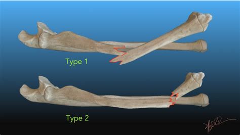 Galeazzi Fracture Dislocation | UW Emergency Radiology