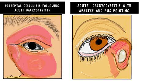 Acute Dacryocystitis v/s Chronic Dacryocystitis - INSIGHT OPHTHALMOLOGY