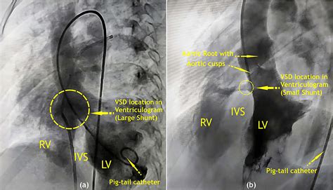 Detecting and Quantifying Residual Intracardiac Shunts Using Oximetric Step-Up Methods: A ...