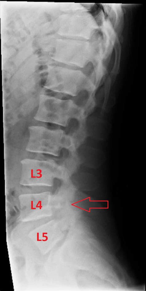 Cureus | Alleviation of Chronic Low Back Pain due to Bilateral Traumatic L4 Pars ...