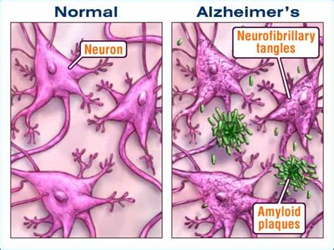 Health Beat: Unfortunately, No Alzheimer's Miracle is in Sight ...