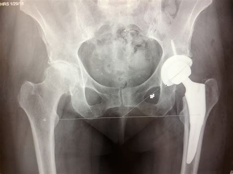 Anterior Hip Replacement Surgery: An Overview - OSMS - Orthopedic and Rheumatology Services in ...