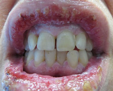 Similar but different: distinguishing between pemphigus vegetans and pyostomatitis-pyodermatitis ...