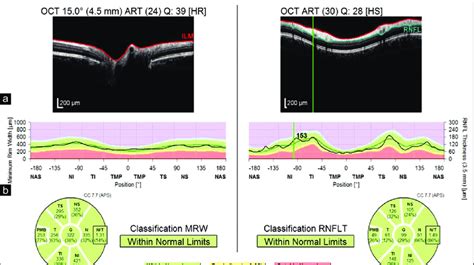 SD-OCT of the right eye of a patient showing normal RNFL values in all... | Download Scientific ...