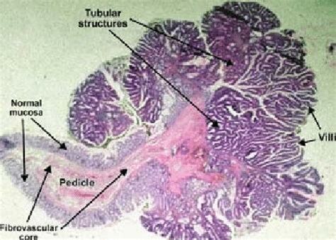 Tubulovillous adenoma cell [15]. | Download Scientific Diagram