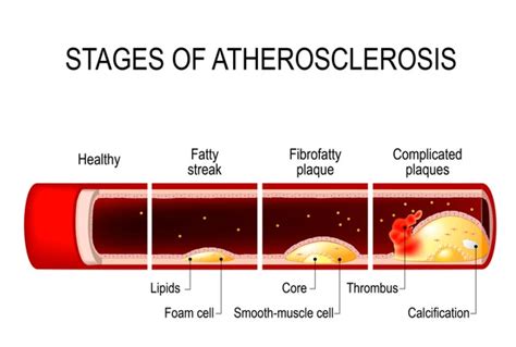 Arterial Calcification: Over 38 Royalty-Free Licensable Stock ...