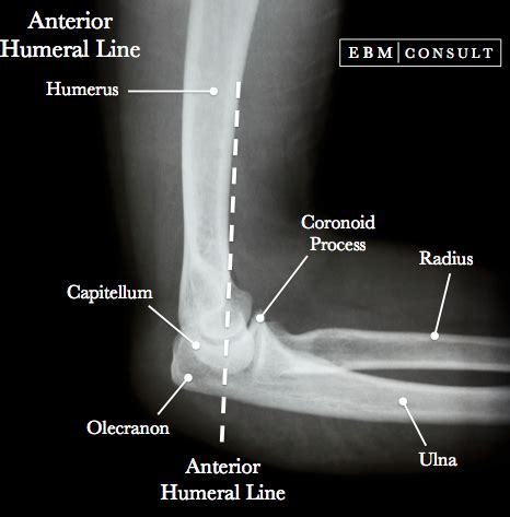 Anterior Humeral Line | Medical radiography, Radiology imaging, Radiology student