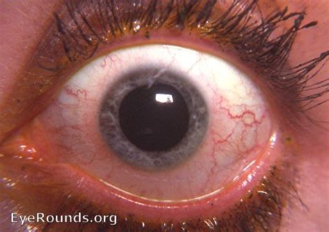 Uveitis with iris atrophy and fixed, dilated pupil. EyeRounds.org ...