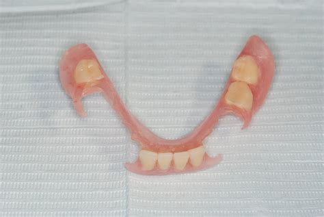 The gallery for --> Lower Partial Dentures