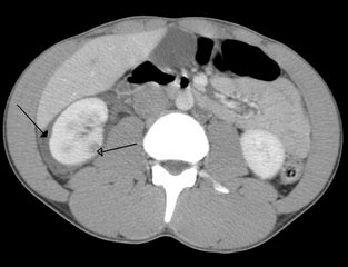 Bruised Kidney: Causes, Symptoms & Treatment | Study.com