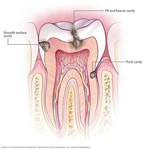 Cavities and tooth decay - Diagnosis and treatment - Mayo Clinic