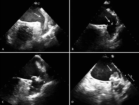 Transesophageal echocardiography images. (A) Left atrial appendage with ...