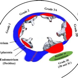 Histologic grading classification of placenta accreta spectrum (PAS)... | Download Scientific ...