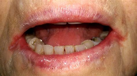 Angular stomatitis - Definition of Angular stomatitis