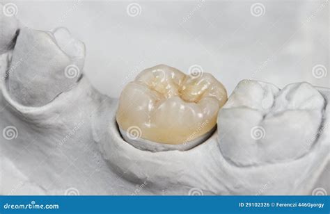 Dental overlay stock photo. Image of onlays, model, porcelain - 29102326