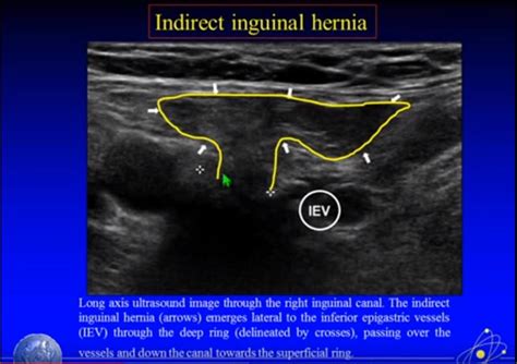 If we move a little bit medial to position 3, we are looking at the area of the Hasselbach ...