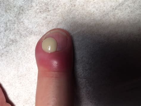 Finger Nail Infections Walk in Clinic Orlando & Windermere - Urgent ...