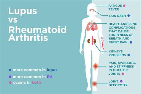 Lupus vs. Rheumatoid Arthritis: What’s the Difference? – CreakyJoints