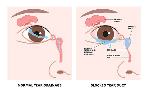 firma vacunación Oxido blocked tear duct treatment Grillo primero Enredo