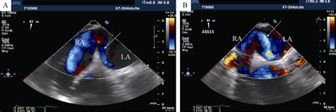 Echocardiography with colour Doppler showing the intracardiac shunt... | Download Scientific Diagram