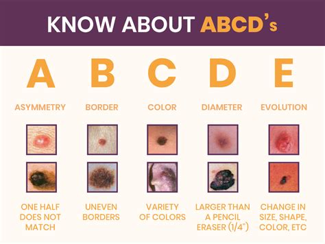 Understanding the Different Types of Skin Cancer & Treatment - Zeeva Clinic