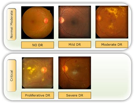 Healthcare | Free Full-Text | Deep Learning-Based Prediction of Diabetic Retinopathy Using CLAHE ...