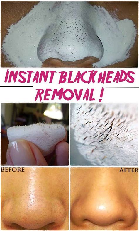 Remove The Blackheads On Your Nose With This Simple Remedy - healhty ...