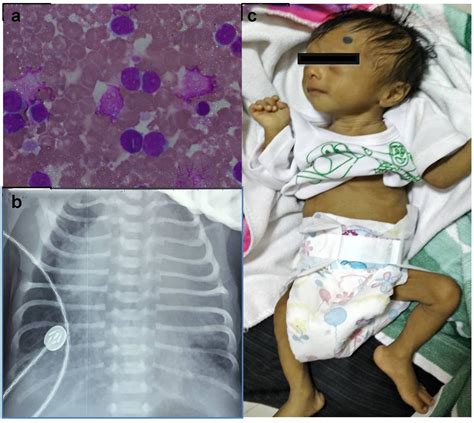 Transient Abnormal Myelopoiesis: A Varied Spectrum of Clinical ...