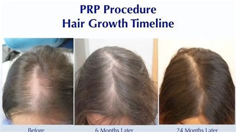 How Long Does PRP Take to Work for Hair Loss? by DuskySkin